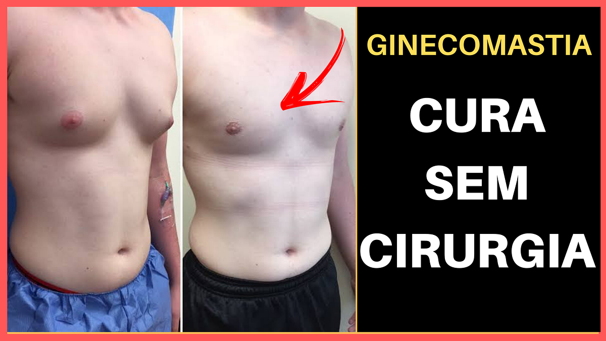 Ginecomastia Causas. Saiba como se livrar deste mau que é a… | by