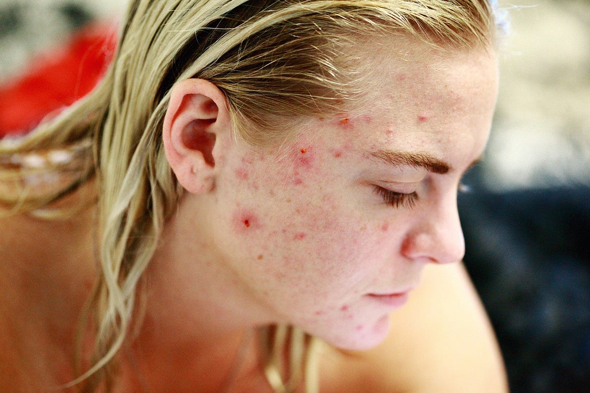 nizoral cream for acne