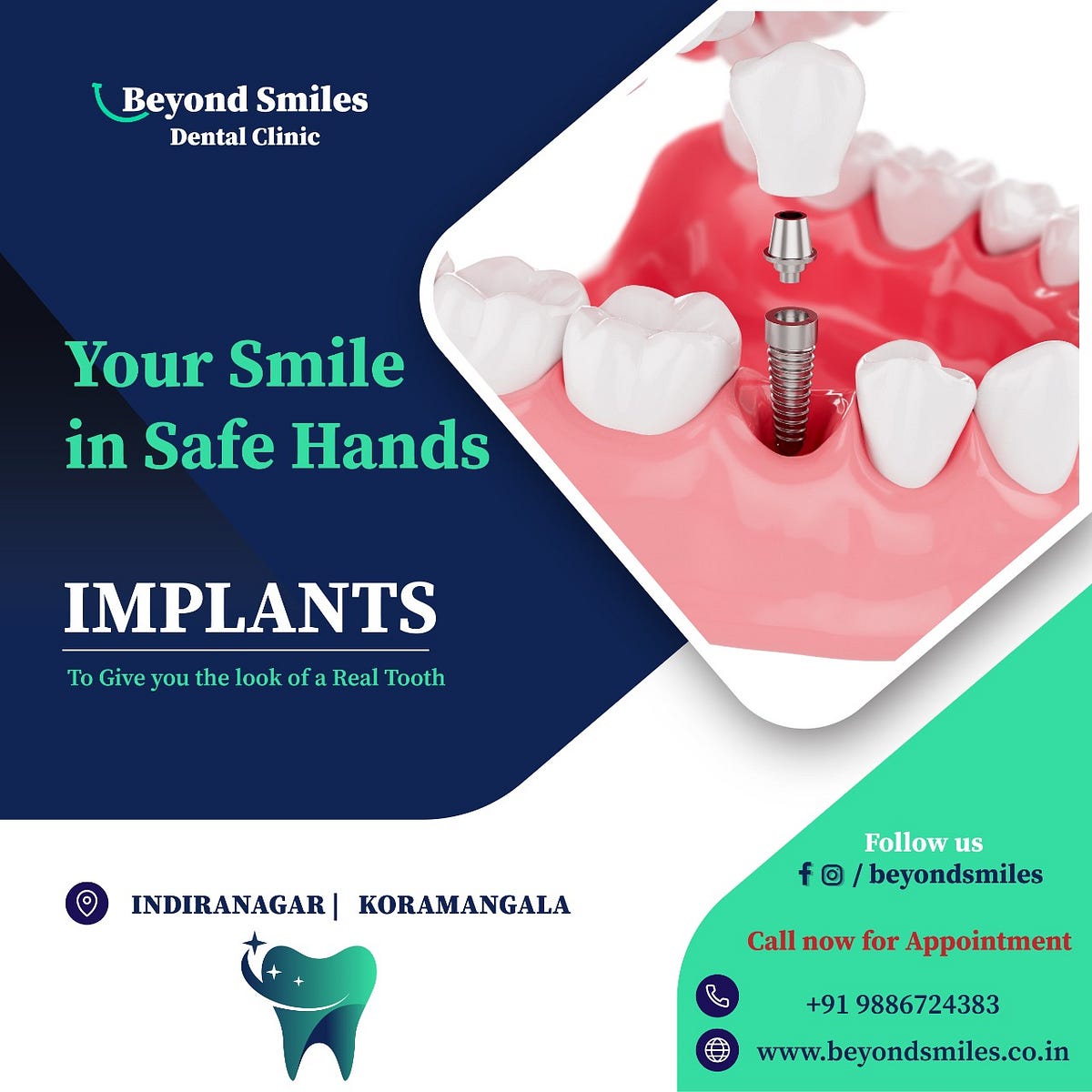 Full Dental Implant cost in Bangalore | by Beyondsmiles Indiranagar | Sep, 2022 | Medium