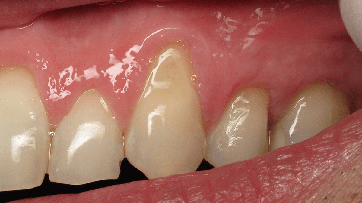 How Do You Stop Receding Gums?