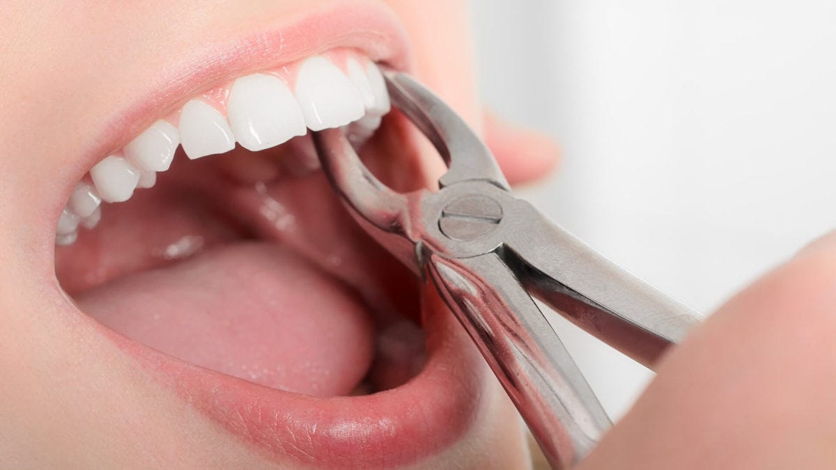 What Is Tooth Extraction?. The day has come when your dentist… | by Rani  kumari | Medium