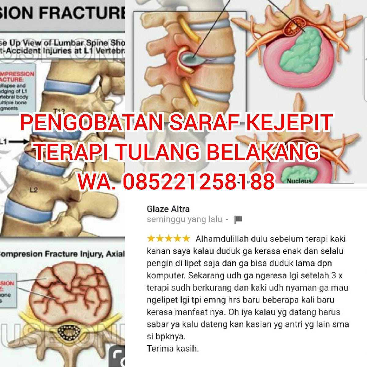 Saraf Kejepit Ini Penyebab Gejala Dan Cara Mengatasinya