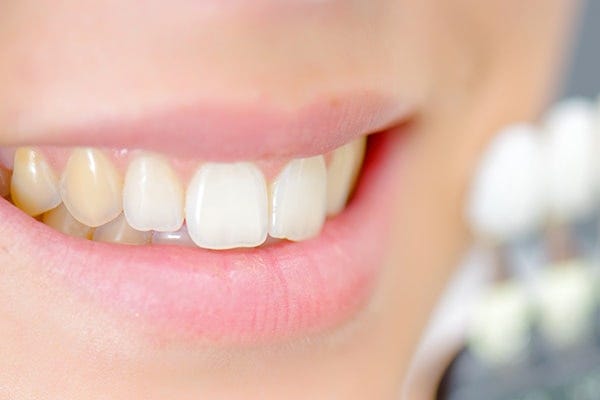 Yellow Teeth In Children