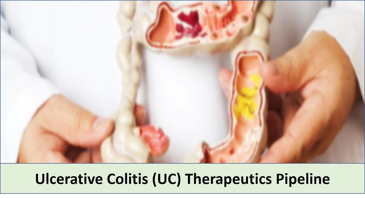 latest research ulcerative colitis