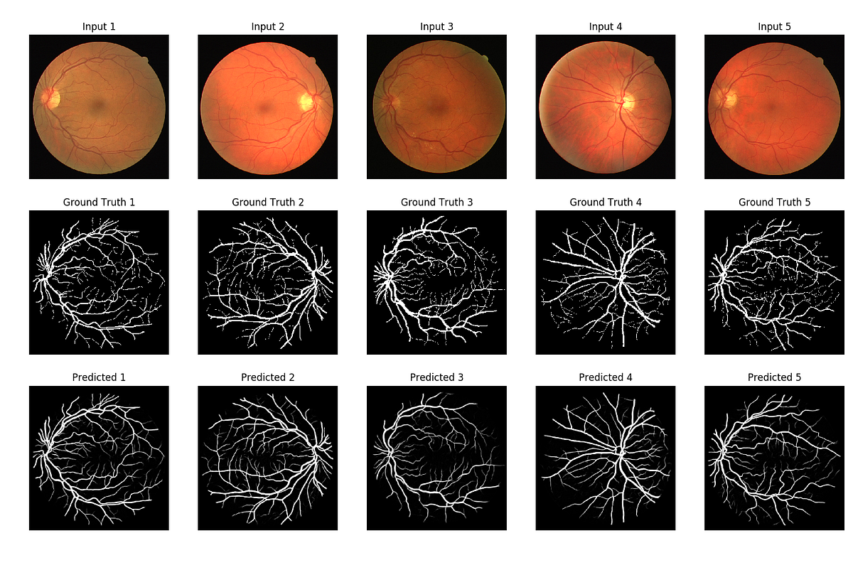 Vessel Segmentation With Python and Keras by Youness Mansar Towards