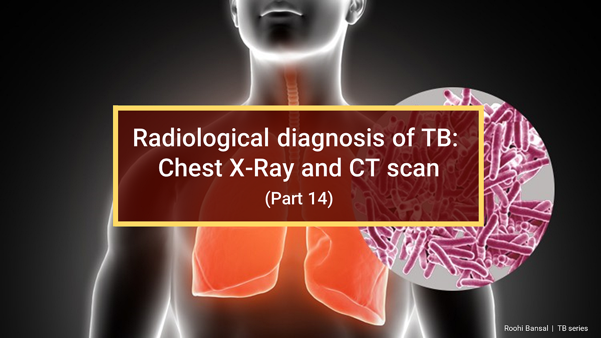 Radiological diagnosis of TB Chest XRay and CT scan (Part 14) by