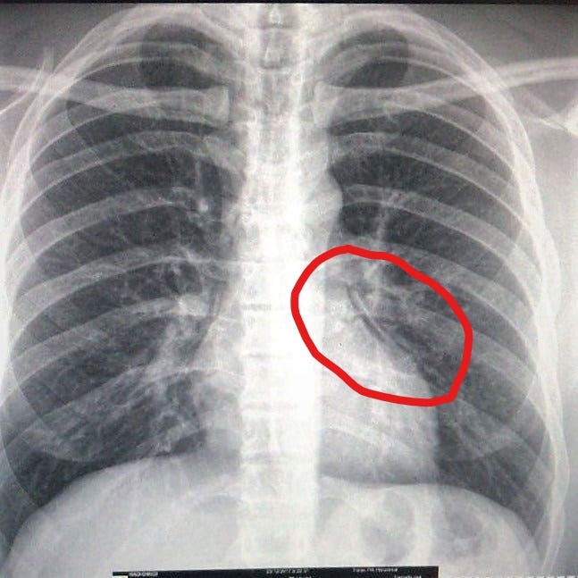 Atelectasis from packing — I had a hole in my lung. How? What? Learnings.