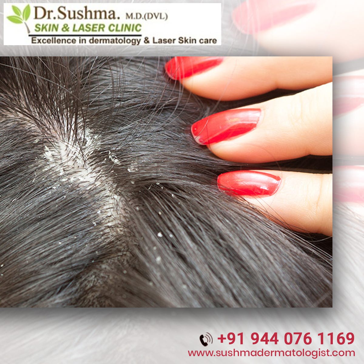 dandruff treatment clinic near me