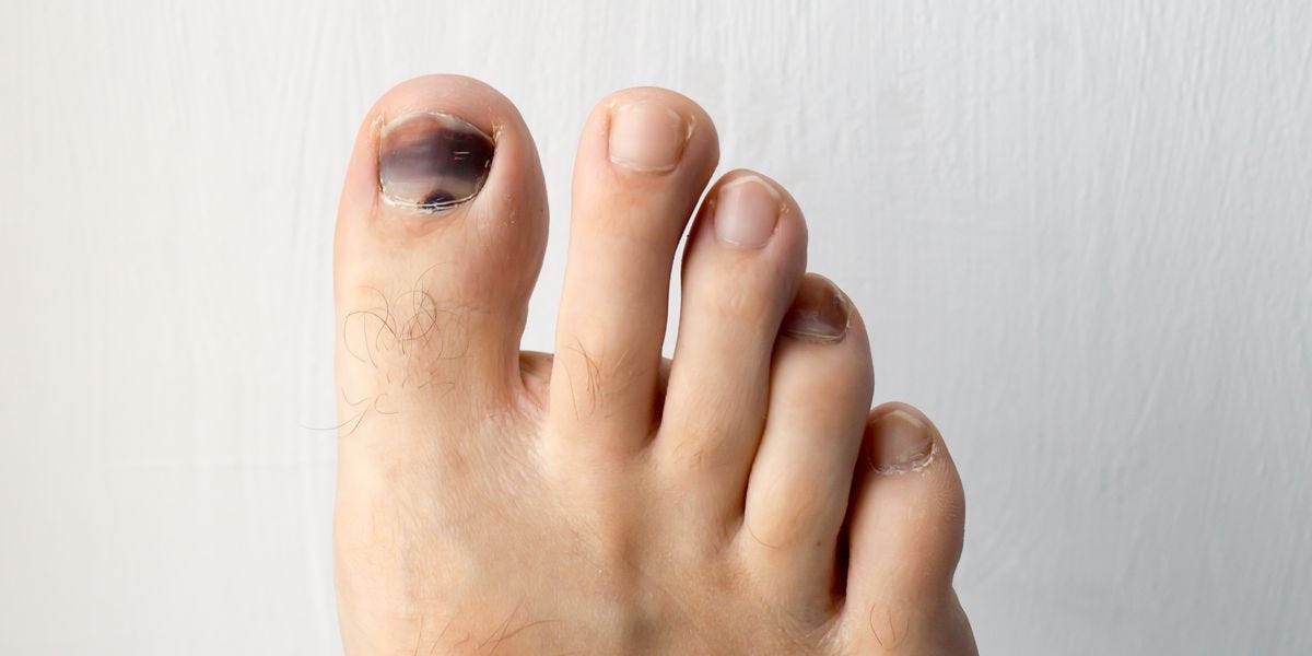 Black Toenail Fungus — Best Way to Get Rid of Toenail Fungus by Abdul