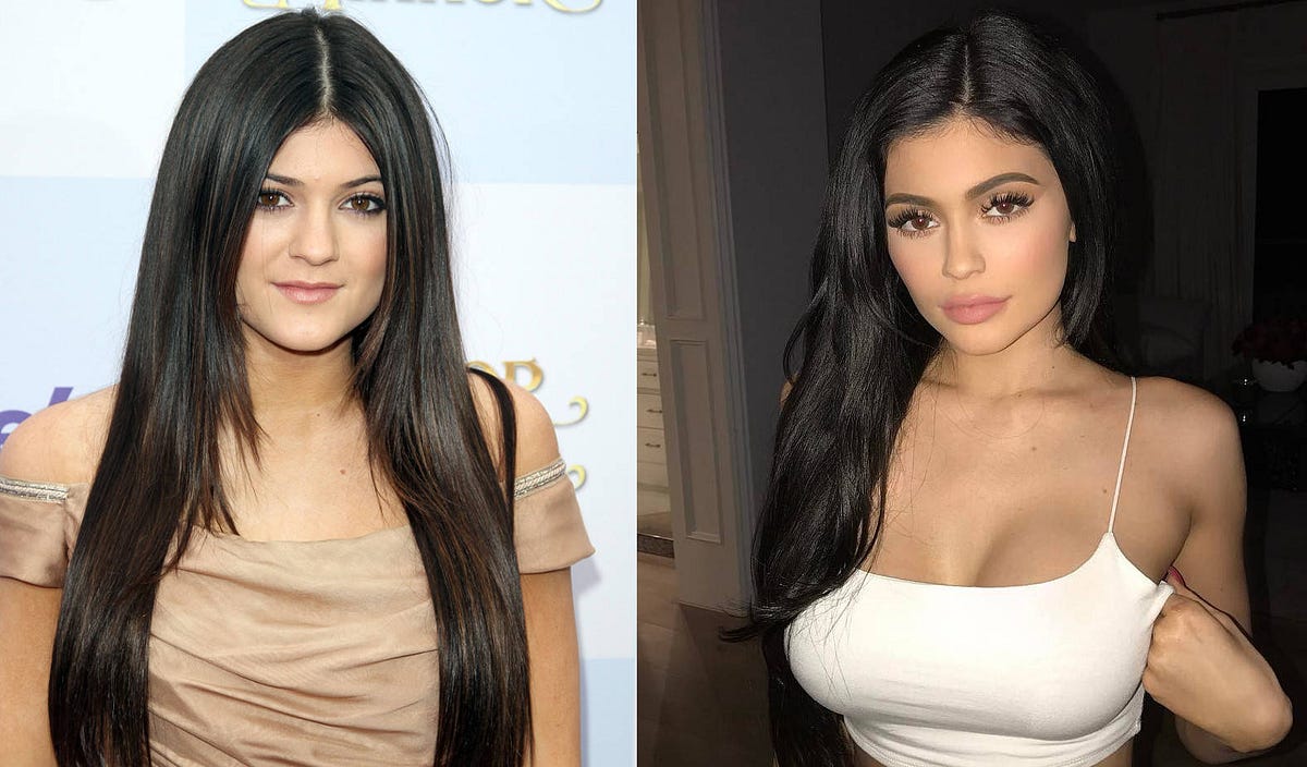 Kylie Jenner’s Plastic Surgery — Spent nearly 2 Million Dollars to Look Kylie Jenner Plastic Surgery Transformation 2025