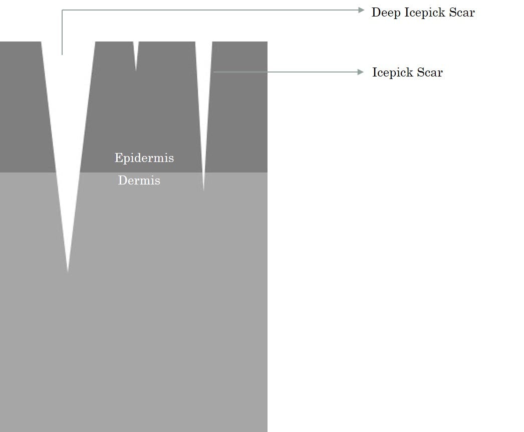 TCA — CROSS, and how it works for Ice Pick Scars by Dr Renita Rajan