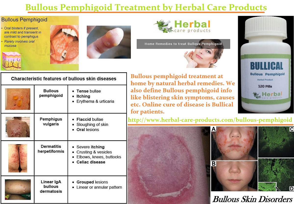 Bullous Pemphigoid Information With its Treatment Technique by
