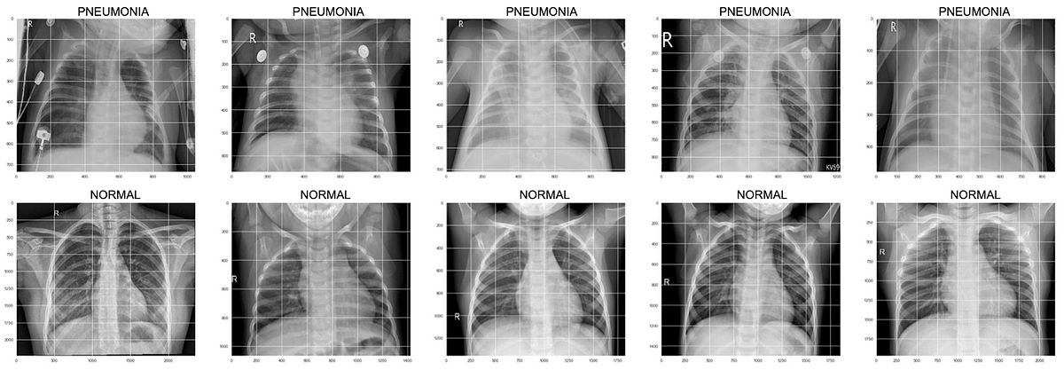 Pneumonia Detection From X-ray Images Using Deep Learning Neural Network