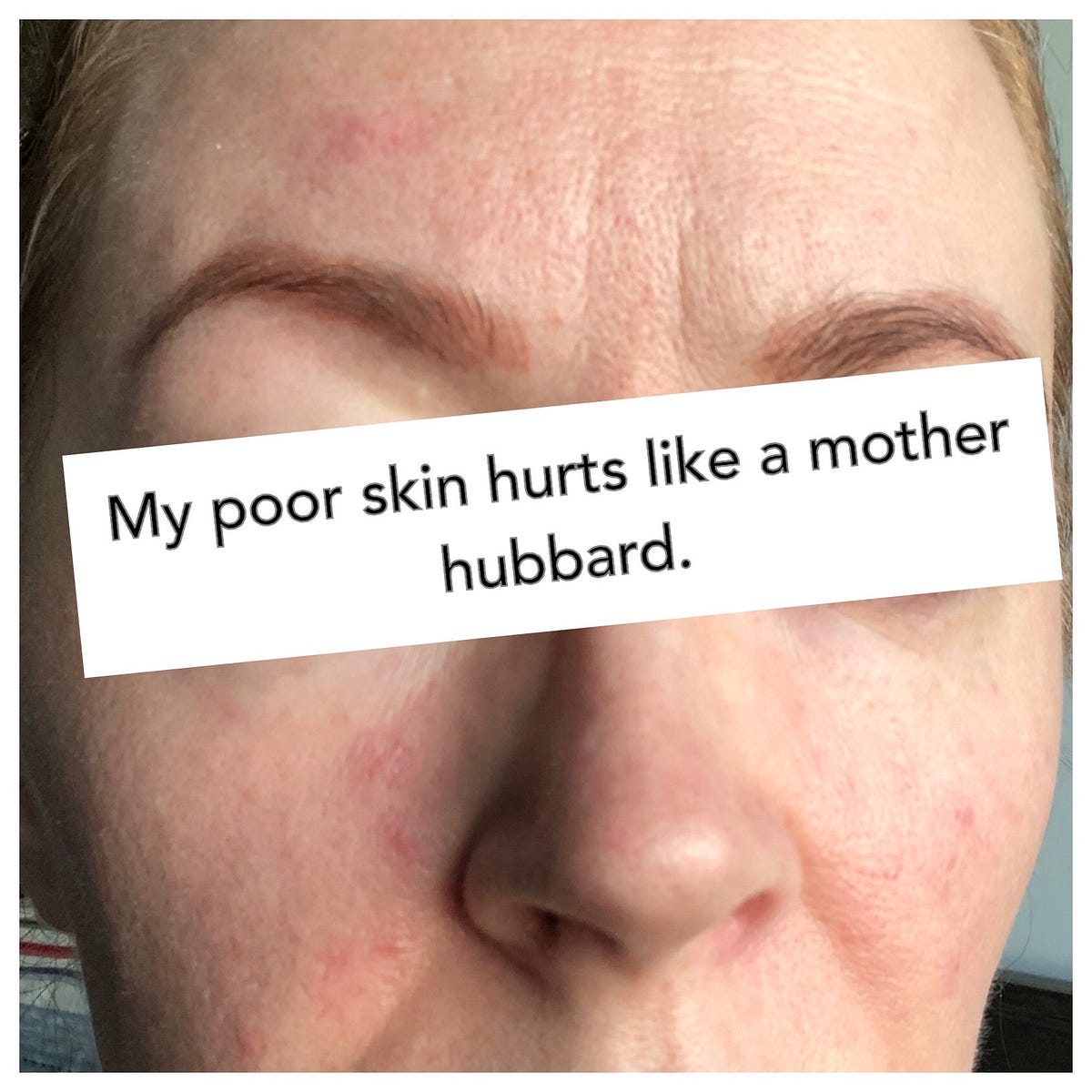 best moisturizer for papulopustular rosacea