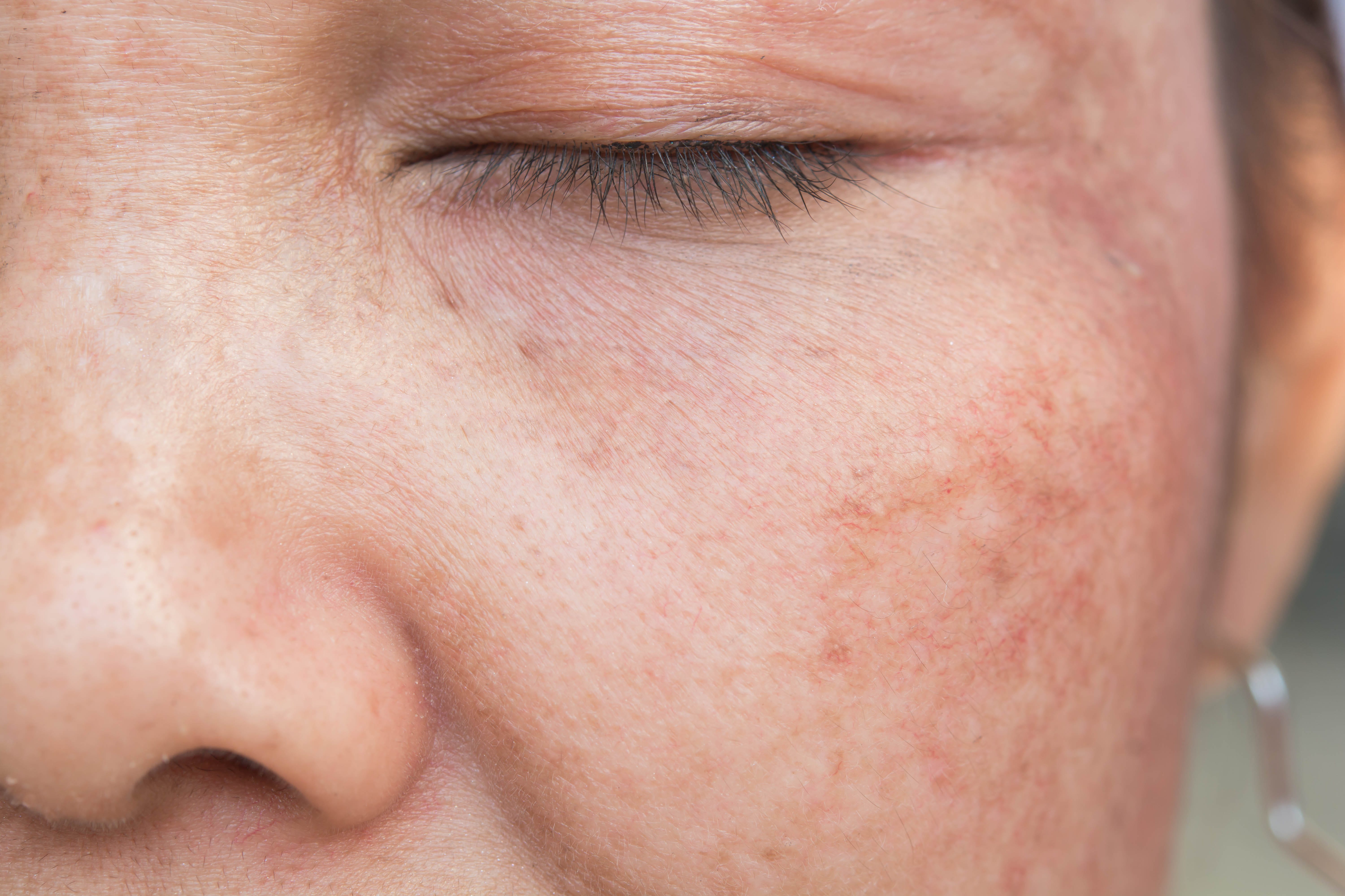 What are age spots and what causes them? | by Bold.Cosmetics | Medium