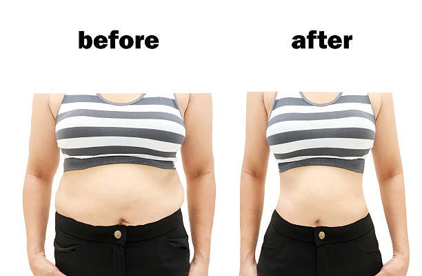 Before and After Weight Loss