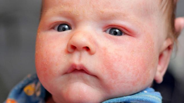 Eczema in babies — how to care?. Have you ever heard about eczema in ...