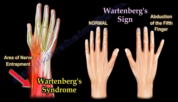 Intersection Syndrome Mayo Clinic Pregnancy Informations