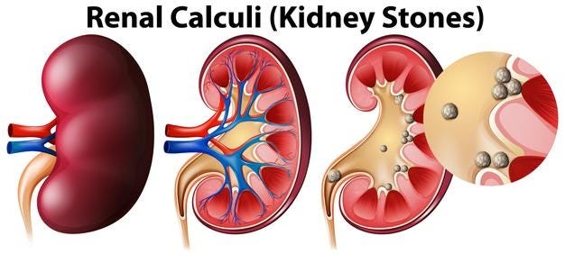 Ayurvedic kidney stone treatment