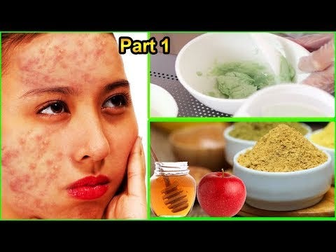 natural acne tips