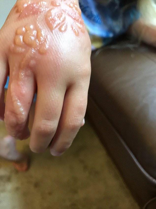 Tragedy Caused By Black Henna Tattoos By Wormhole Tattoo Medium