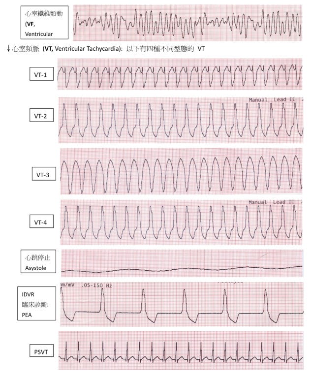 ACLS 常見之心電圖 | by 臨床筆記 | Medium