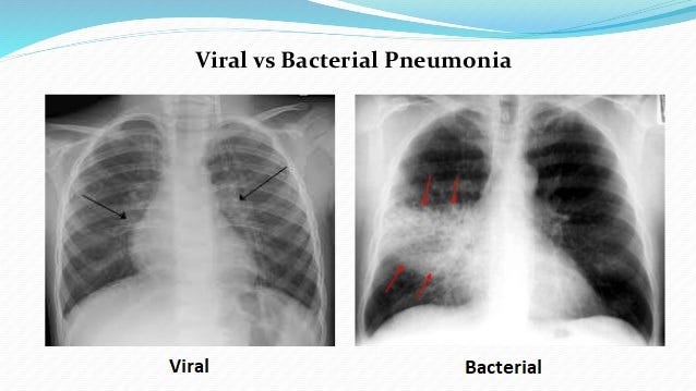 pneumonia-chest-x-rays-image-classifier-by-abhik-jha-medium