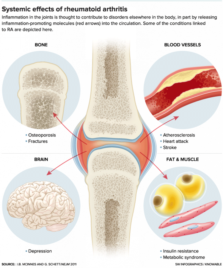 The Complex Riddles of Rheumatoid Arthritis by Knowable