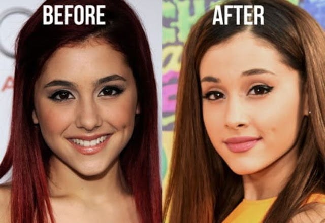 ARIANA GRANDE PLASTIC INSIGHT. ARIANA GRANDE PLASTIC INSIGHT | by VIEW  PLASTIC SURGERY | Medium