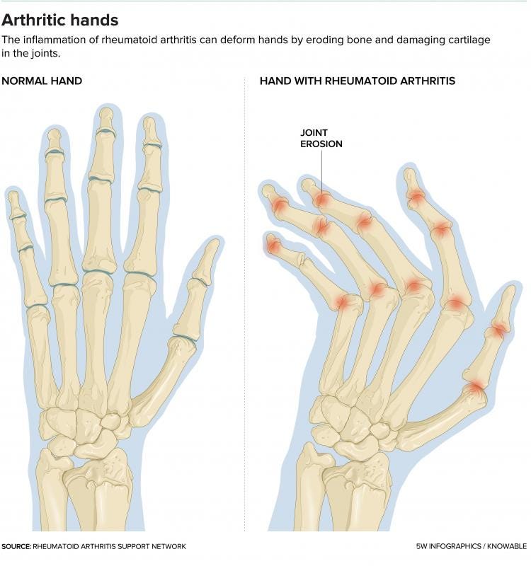 The Complex Riddles of Rheumatoid Arthritis | by Knowable Magazine ...