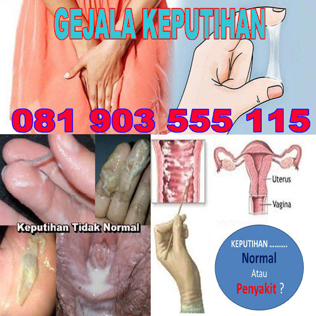 cara mengatasi gatal pada kemaluan akibat keputihan