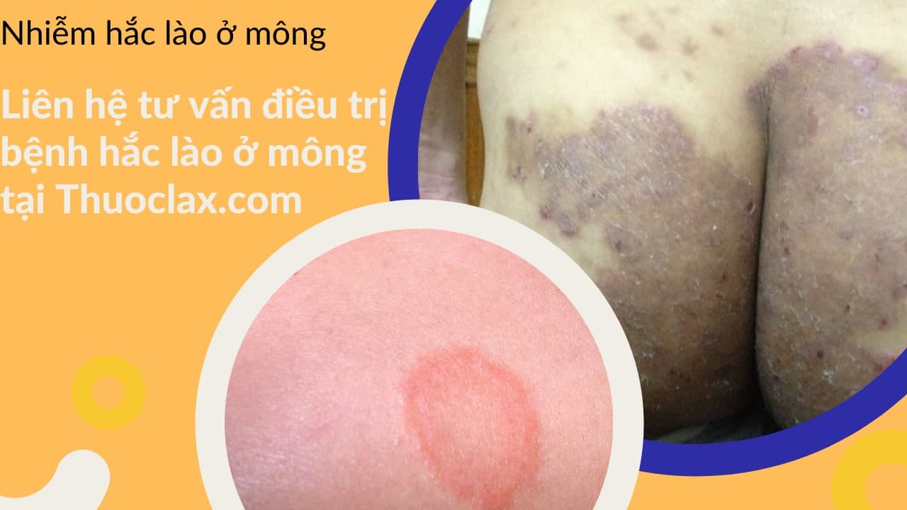 Bệnh hắc lào ở mông