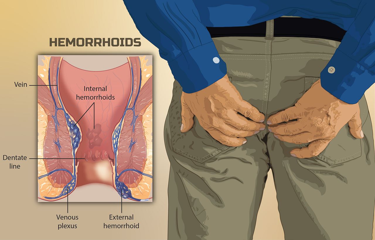 How to STOP Hemorrhoid Pain at Home ?? | by Reading | Medium