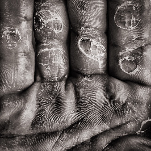 Rowing Blisters 101. Blisters suck — this we can all agree… by