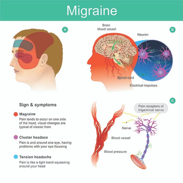 Migraine Cure