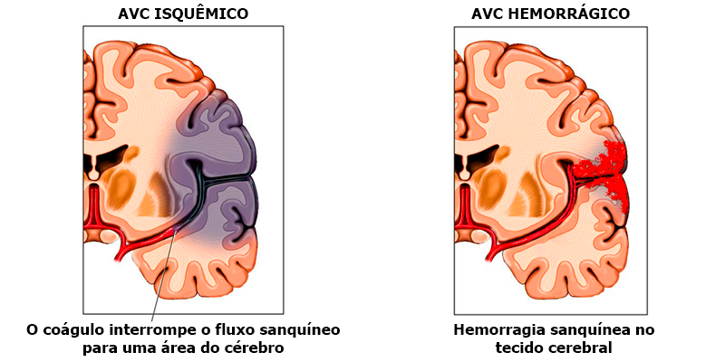 ENTENDA O QUE É AVC OU DERRAME CEREBRAL E COMO PREVENI-LO | by Dicas de ...