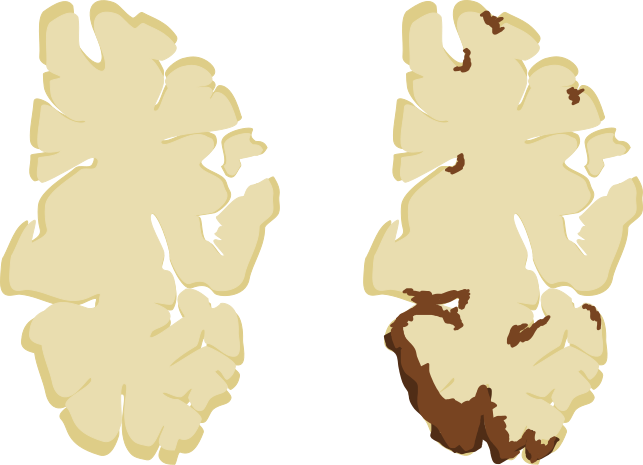 Football S Cte Problem Is Real Divulging The Nfl S Dismissal Of The Disease And Downplaying Of Concussion Issues By Michael Dong Medium