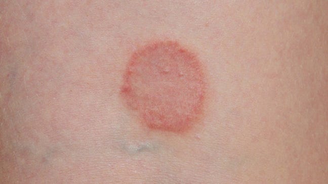 How to Treat Ring Worm commonly termed as A Fungal Infection? | by