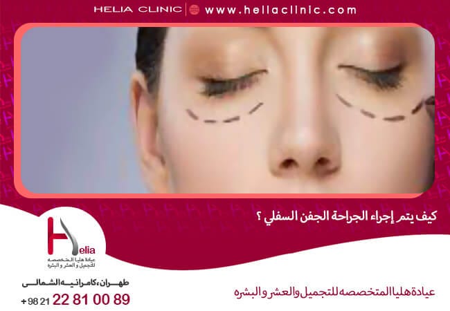 ما هي جراحة الجفن السفلي ما هي جراحة الجفن السفلي بقلم Halia Clinic Medium