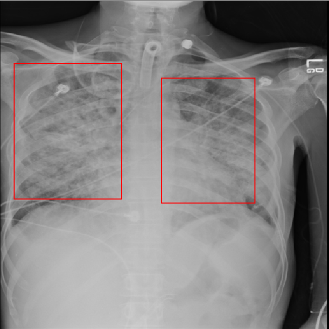 Pneumonia detection from chest radiograph using deep learning by