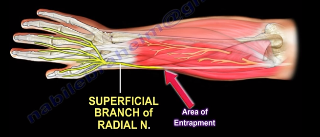 Wartenberg s Syndrome The Superficial Branch Of The Radial By Nabil 