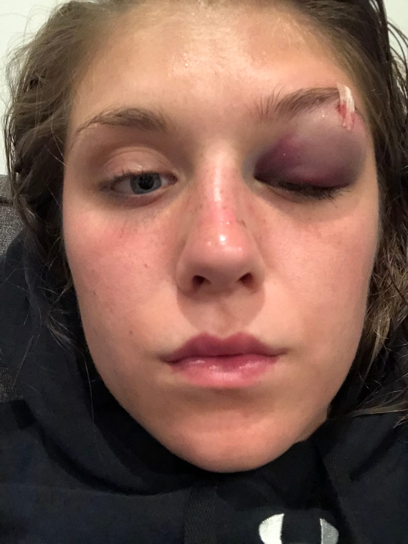 one black eye