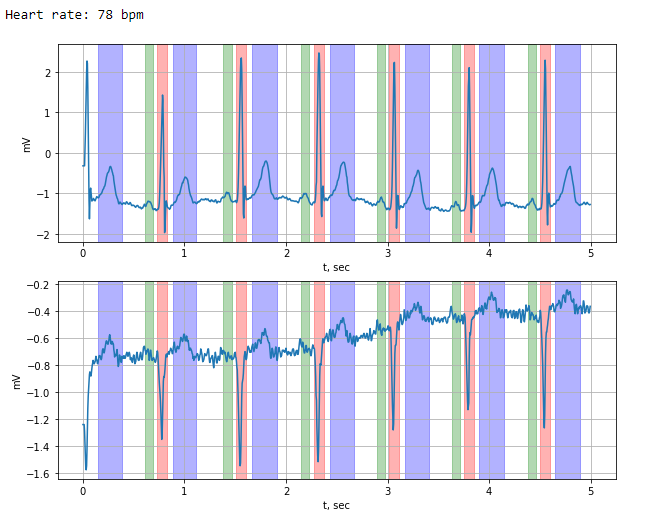 Annotating Ecg Signals With Hidden Markov Model Data Analysis