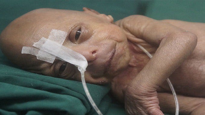 Bangladesh Un Bebe Nait Avec L Apparence D Un Vieillard By E Borealis Minutenews Medium