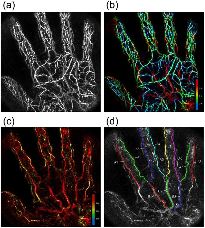 Photoacoustic imaging of a patient’s hand vein patterns