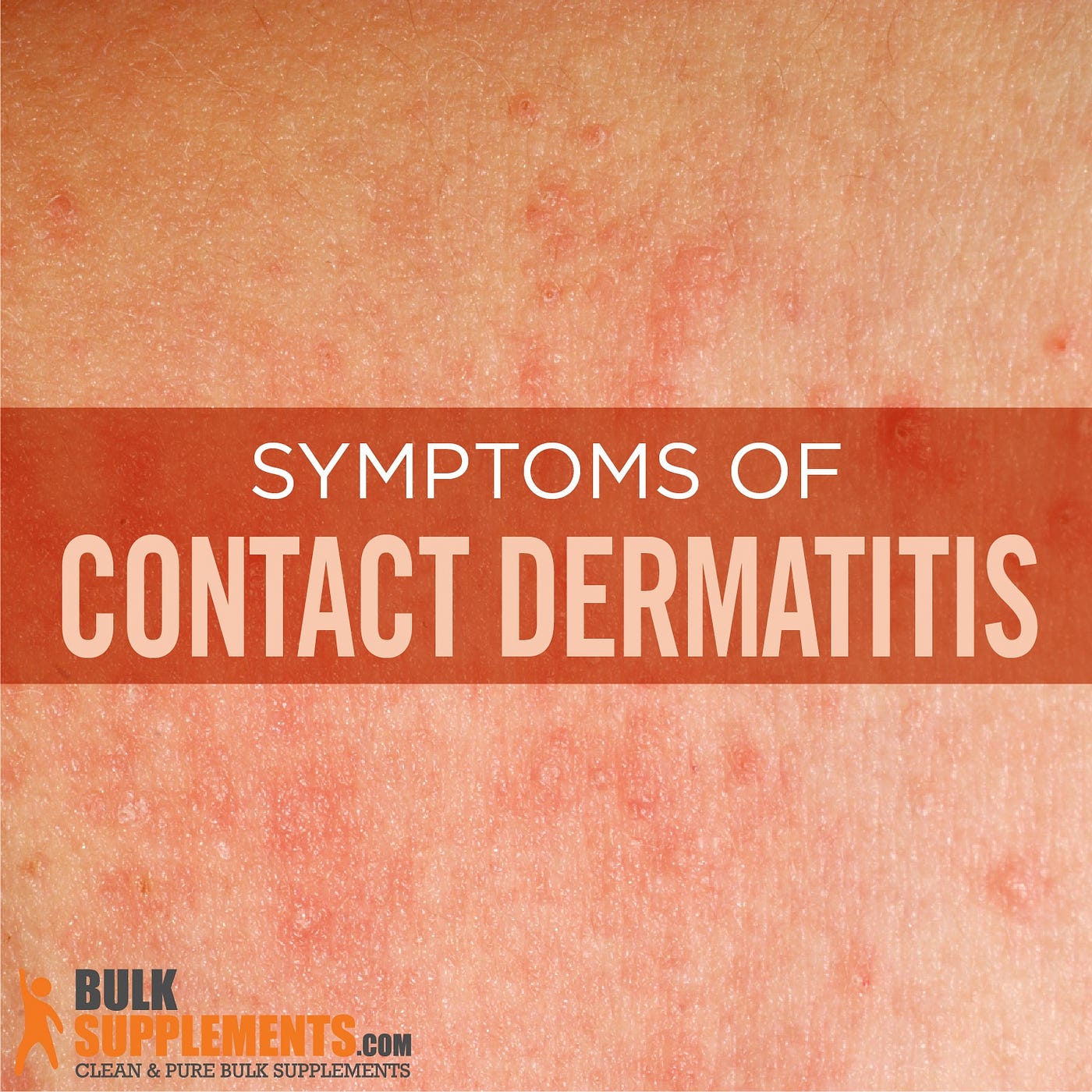 Contact Dermatitis: Symptoms, Causes & Treatment | BulkSupplements.com ...