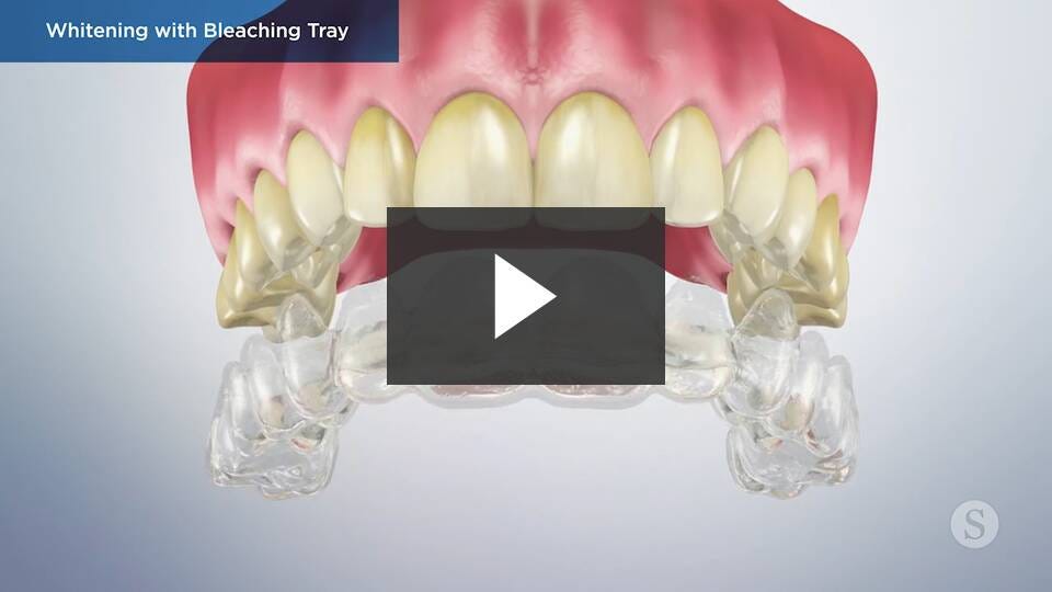 Zoom teeth whitening