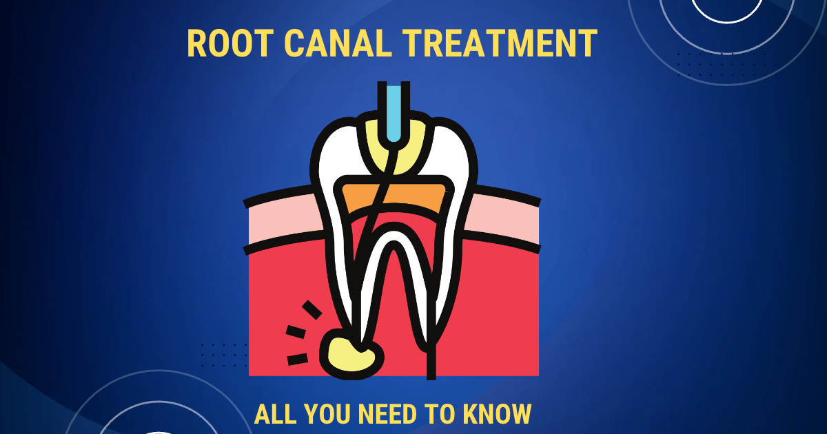 painless root canal treatment