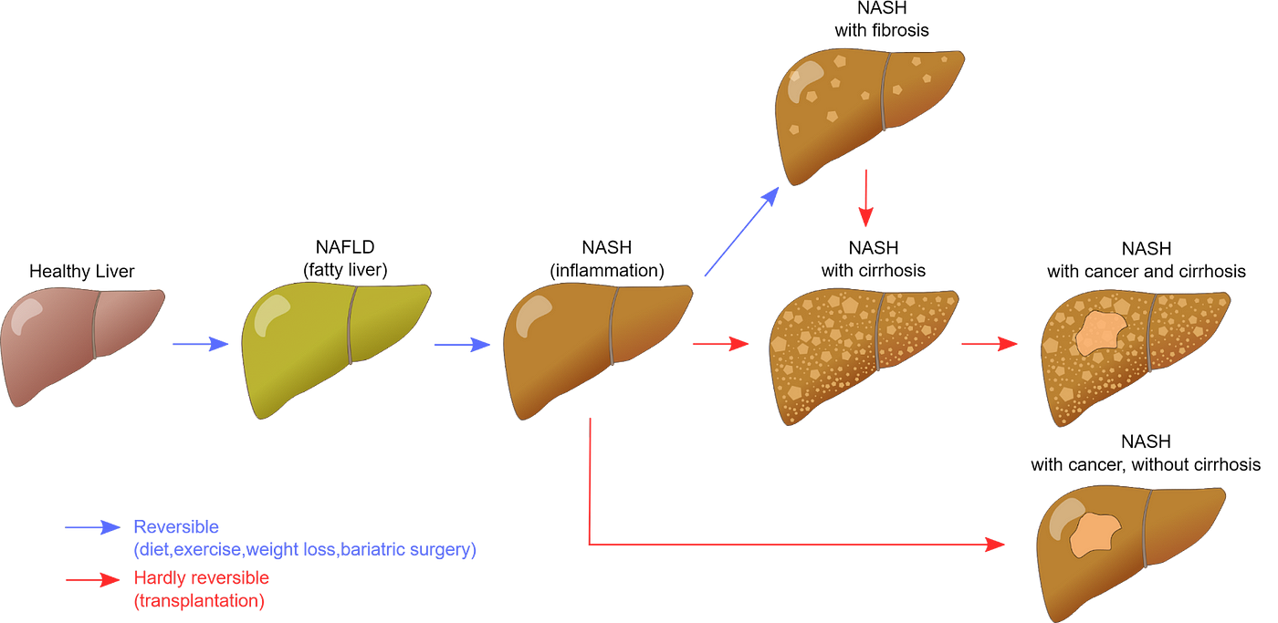 A vector image of different stages of fatty liver.