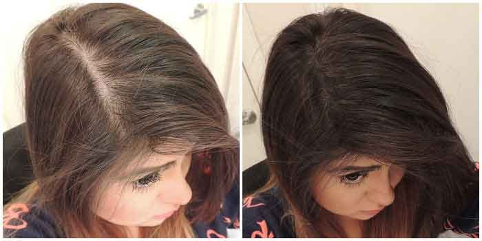 Remedies For Stress Related Hair Loss Hairstyleideas Medium